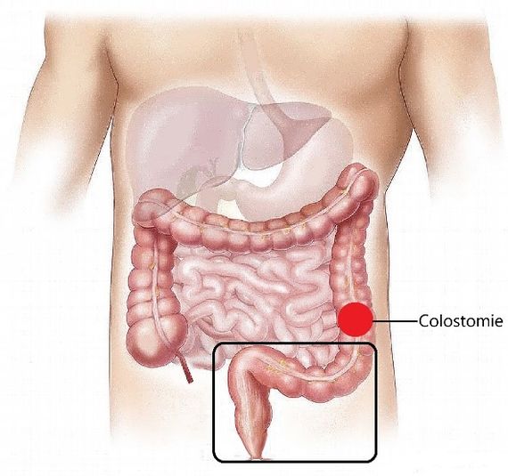Abdominoperineal resection