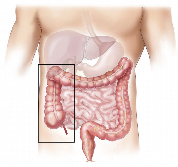 Right hemicolectomy