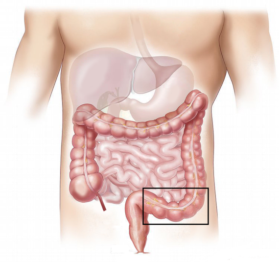 Sigmoidectomy
