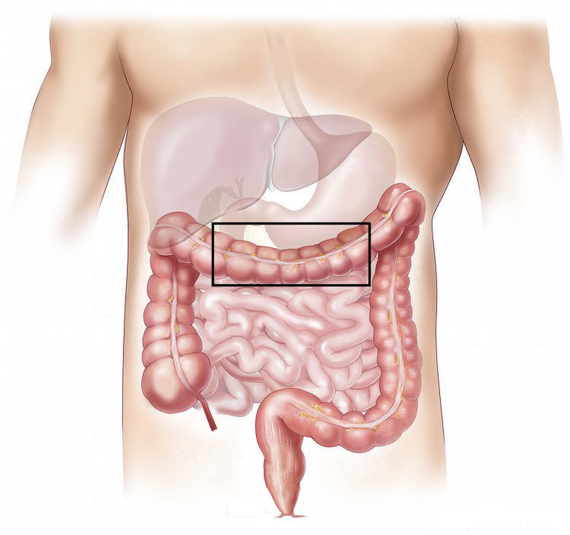 Transverse colectomy