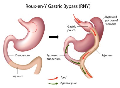 Dérivation gastrique
