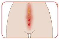 Incision chaude