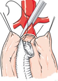 The aorta is clamped