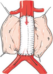 Ouverture de l’anévrisme et ablation