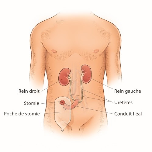 Cystectomie radicale avec conduit iléal