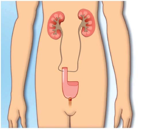 Cystectomie radicale avec néovessie orthotopique